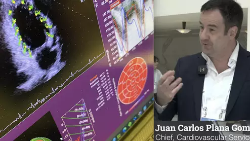 Video of Juan Carlos Plana Gomez MD explaining how to create a cardio-oncology program at ASE 2023. #ASE #ASE23 #ASE2023