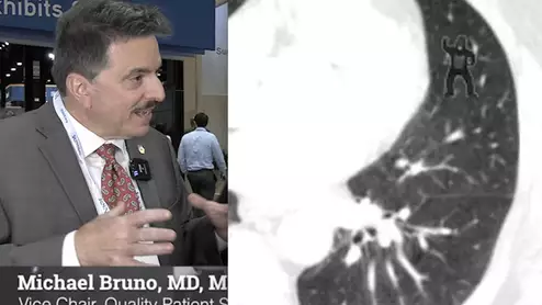 The rate of radiology reading errors has not changed in 75 years, despite technology advances, explains Michael Bruno, MD, Penn State Hershey Medical Center, who outlines the reasons why.