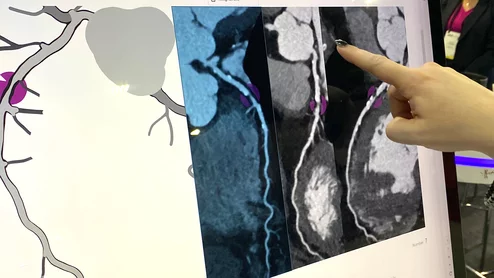 Heartflow Roadmap AI can show the locations and severity of coronary lesions from a CT scan to act as a second set of eyes for imagers, and to better inform referring physicians and patients.