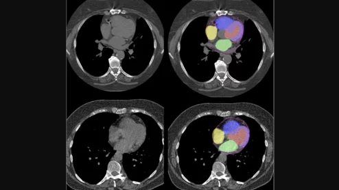Advanced artificial intelligence (AI) models can evaluate cardiovascular risk in routine chest CT scans without contrast, according to new research published in Nature Communications.[1] In fact, the authors noted, the AI approach may be more effective at identifying issues than relying on guidance from radiologists. Representative non-contrast CT slices for two patients (left), with super-imposed segmentations (right). One artificial intelligence (AI) model was used to segment a cardiac mask.