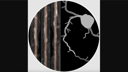 HeartFlow Plaque Analysis. A European Heart Journal – Cardiovascular Imaging study compared the noninvasive Plaque Analysis technology developed by HeartFlow, which uses advanced AI algorithms to evaluate coronary CT angiography (CCTA) images, with coronary plaque assessments achieved by using intravascular ultrasound (IVUS). The REVEALPLAQUE trial included data from 237 patients. Plaque Analysis showed strong correlation and high accuracy when compared with IVUS.