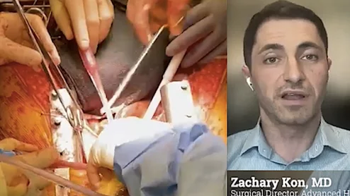 Zachary Kon, MD, surgical director, advanced heart failure and cardiac transplantation at Hofstra/Northwell, explains the current standard for collecting and preserving organs and a the new concept of thoracoabdominal normothermic regional perfusion (NRP)