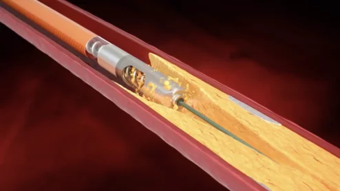 The U.S. Food and Drug Administration (FDA) has shared a new warning about ongoing safety issues with atherectomy devices sold and distributed by Bard Peripheral Vascular, an Arizona-based subsidiary of Becton, Dickinson and Company (BD). The warning includes multiple models of Bard Peripheral Vascular’s Rotarex Atherectomy System, which is designed to target high-risk plaques and blood clots in the peripheral arteries by rotating at a high speed.