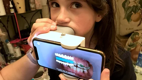 The AI enabled Dental Image Analyzer from DentalMonitoring uses a smartphone to scan a patient's mouth and the AI reconstructs a complete model of the mouth to compare with prior images to track the progress of orthodontic work at home. The FDA cleared the technology in cleared 2024. Photo by Dave Fornell Vivian Fornell