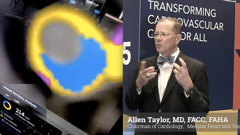 Video interview with Allen Taylor, MD, chairman of cardiology at Medstar, who explains use of AI CCTA plaque analysis at Medstar to improve risk assessments.