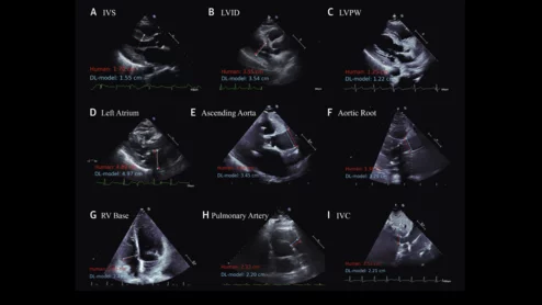 Cardiologists have developed an open-source artificial intelligence (AI) model capable of accurately evaluating a long list of measurements on echocardiography results. The group detailed the development and validation of that model in the Journal of the American College of Cardiology. A comparison of measurements made by a sonographer (in red) and predictions from the deep learning model (in light blue) across 9 echocardiographic parameters. Image and caption courtesy of Ouyang et al., JACC.
