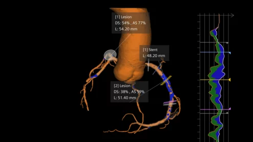 Siemens Healthineers software Syngo.CT Coronary Cockpit