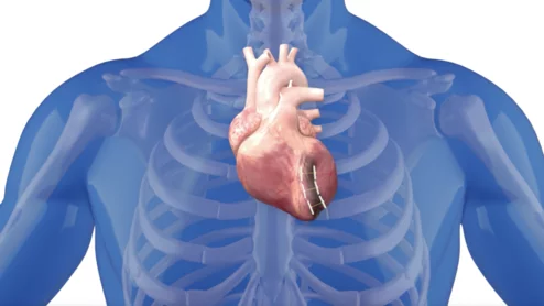 BioVentrix's Revivent system