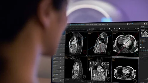 Philips has secured U.S. Food and Drug Administration (FDA) clearance for SmartHeart, the company’s new artificial intelligence (AI)-powered planning technology for cardiac MR (CMR) exams.