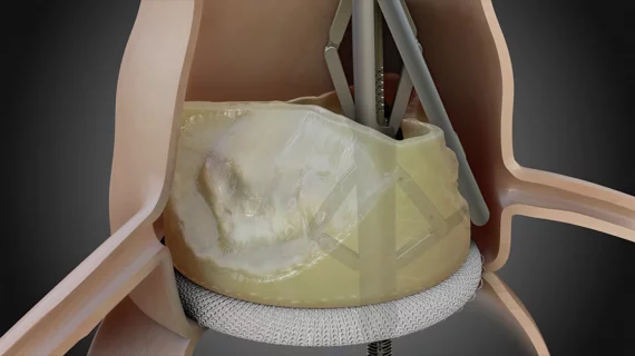 Pi-Cardia ShortCut TAVR device