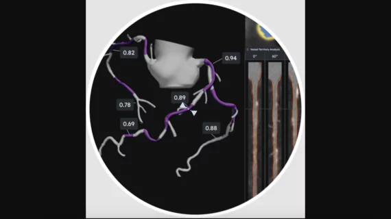 HeartFlow Plaque Analysis Example