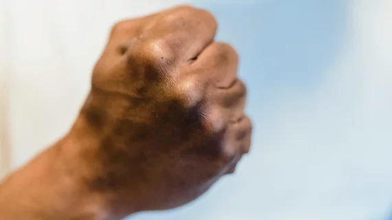 Fist punch assault