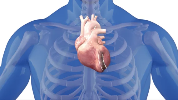 BioVentrix's Revivent system